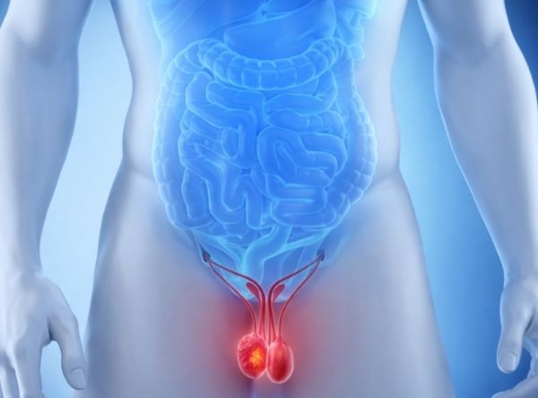 Robotic Surgery for Testicular Cancer