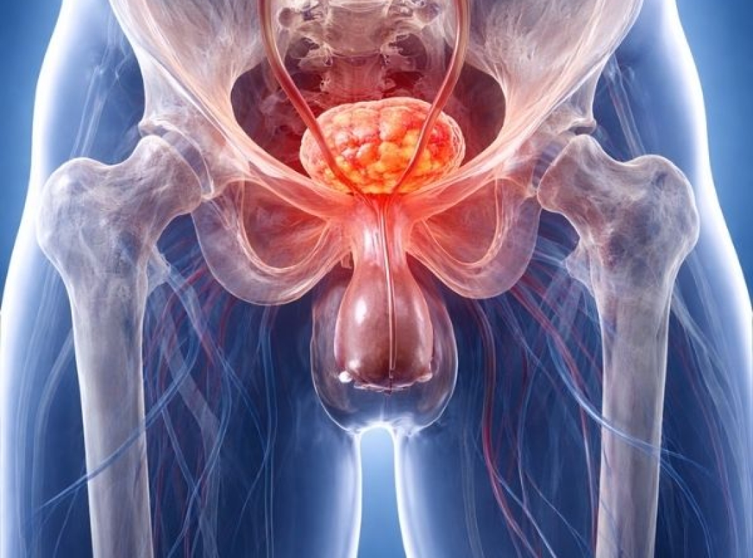 Robotic Surgery for Prostate Cancer