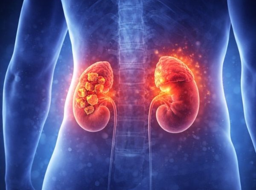 Kidney Diseases