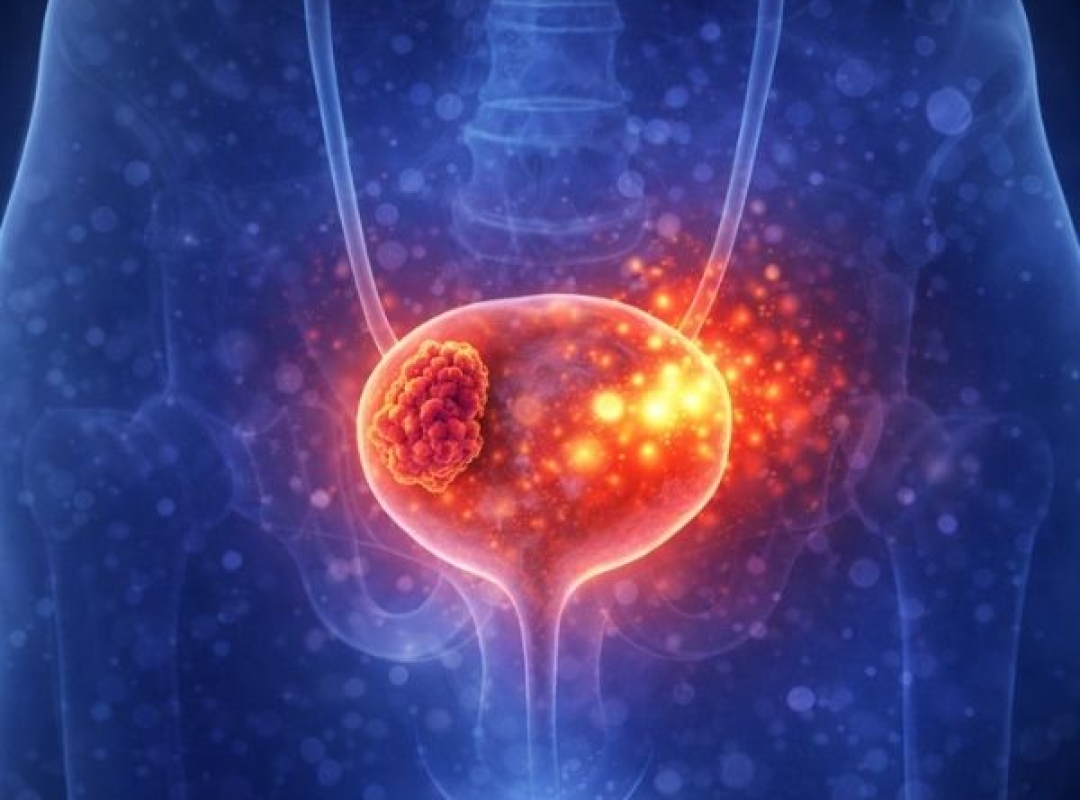 Bladder (Urinary Bladder) Diseases