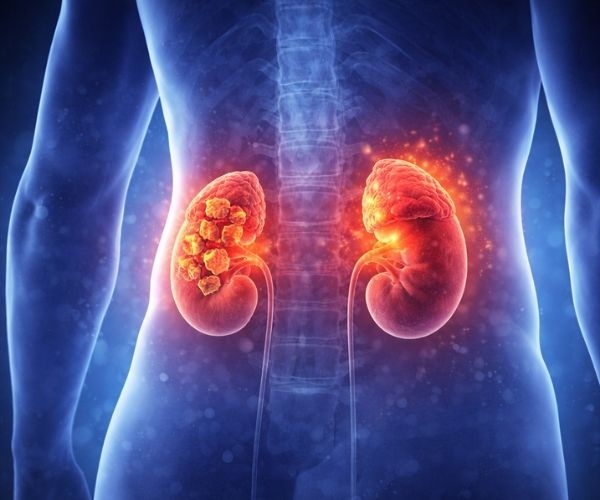Kidney Diseases