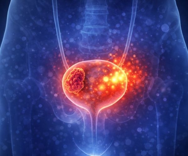 Bladder (Urinary Bladder) Diseases